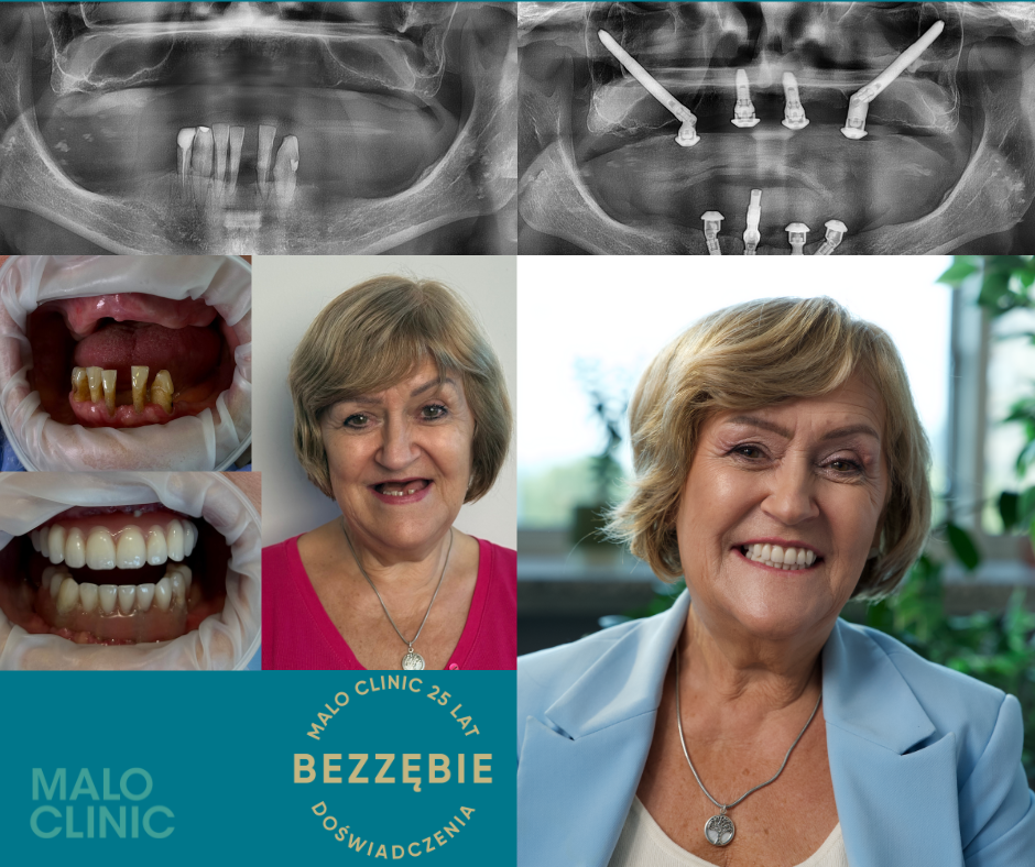 All-on-4 Hybrid All-on-4 Hybrid